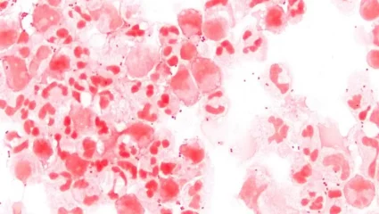 Μηνιγγίτιδα: SOS για σπάνια βακτηριακή λοίμωξη -Τα ασυνήθιστα συμπτώματα