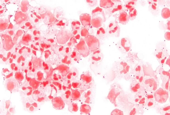 Μηνιγγίτιδα: SOS για σπάνια βακτηριακή λοίμωξη -Τα ασυνήθιστα συμπτώματα